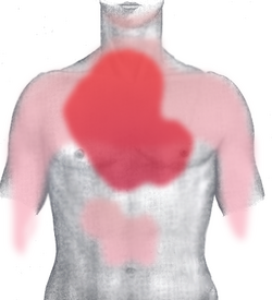 Pain in acute myocardial infarction